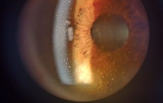 uveitis-min